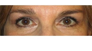 Manhattan BLEPHAROPLASTY after 1